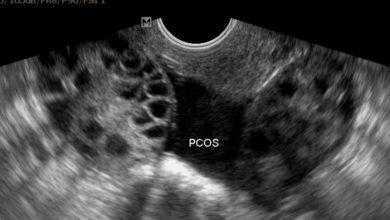 حديثة تقربنا كثيرًا من الفهم الكامل لمتلازمة تكيس المبايض