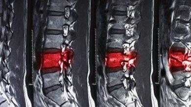 نجاح المرحلة الأولى لعلاج إصابات الحبل الشوكي باستخدام الخلايا الجذعية