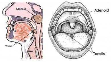 استئصال اللحمية واللوزتين يزيد من خطر الإصابة بالأمراض التنفسية