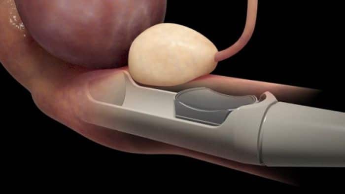 علاج سرطان البروستاتا باستخدام الموجات فوق الصوتية