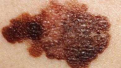 اختبار دم جديد للكشف عن سرطان الجلد بدقة تفوق دقة الخزعة