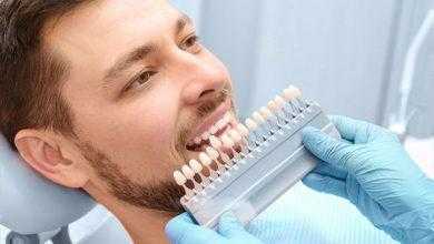 تبييض الأسنان ... تطوير طريقة آمنة وفعالة للحصول على أسنان بيضاء كاللؤلؤ