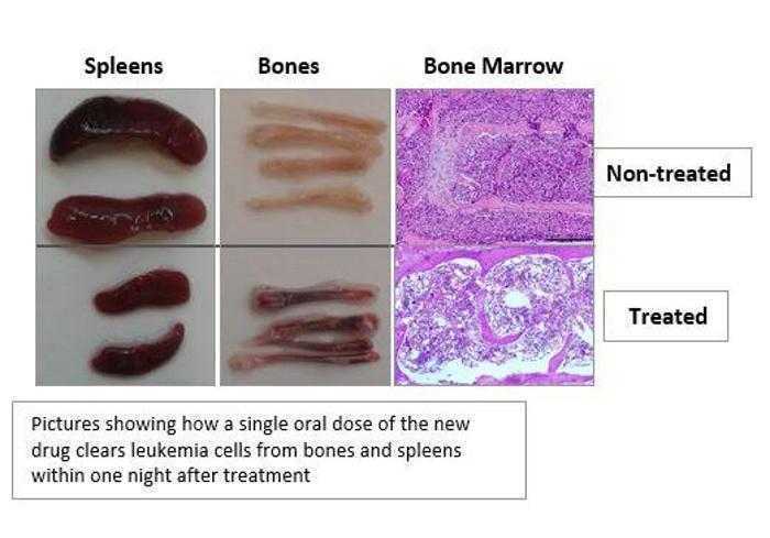 علاج جديد لسرطان الدم الحاد