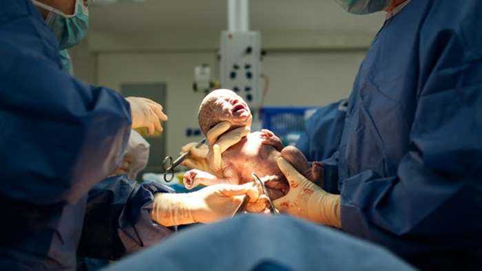 الحد من إجراء الولادات القيصرية