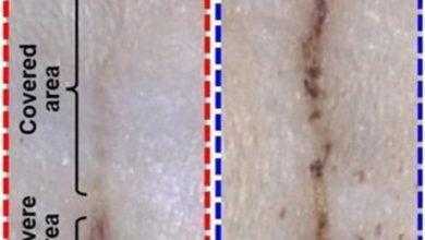 تطوير ضمادة إلكترونية تساعد على سرعة التئام الجروح