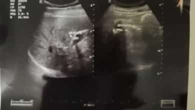 تفتيت حصى المرارة بدون جراحة