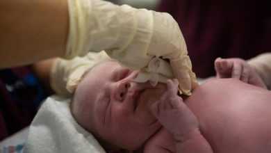 تكرار الولادة القيصرية