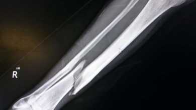 الإصابة بكسور العظام في النساء