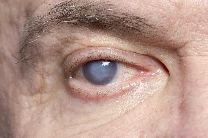 قطرات طبية للعين لعلاج عتامة العدسة