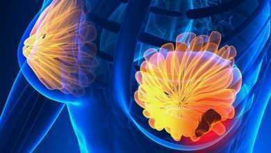 الإصابة بسرطان الثدي