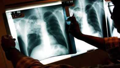 حقن لقاح السل (BCG) مُباشرة في الوريد