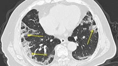 الآشعة المقطعية
