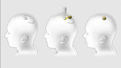 زرع شريحة ذكية بداخل دماغ خنزير