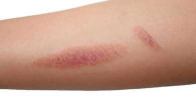 8 أخطاء شائعة في التعامل مع الحروق