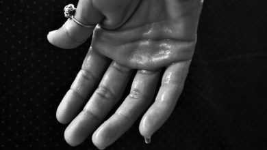 فرط تعرق اليدين ... كيف يمكن علاجه