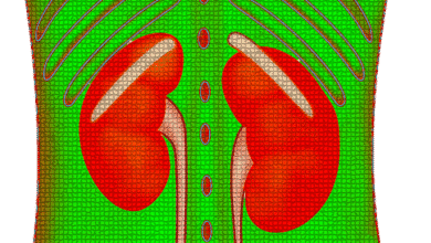 ما هي أعراض حصوة الحالب ؟