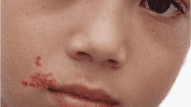 مرض الحزام الناري | هل الحزام الناري معدي