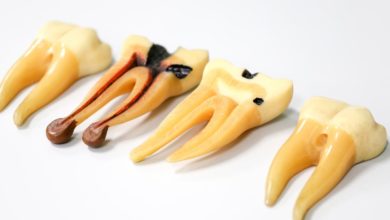 أسباب تسوس الأسنان