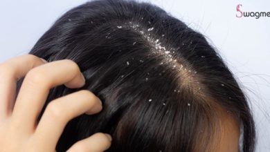 علاج قشرة الشعر