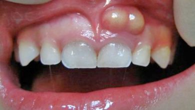 خراج الأسنان