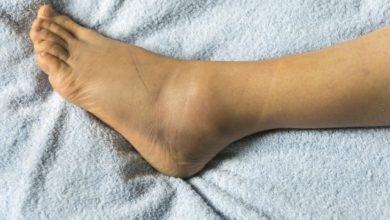 أسباب تورم القدمين