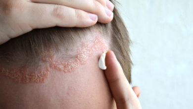 التهاب الجلد الدهني