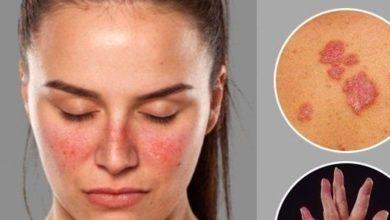 نصائح لمرضى الذئبة الحمراء