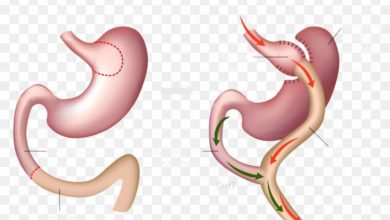 عملية تحويل مسار المعدة