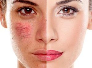 أضرار إزالة الشعر بالليزر