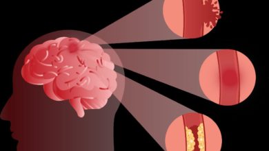 أنواع السكتة الدماغية