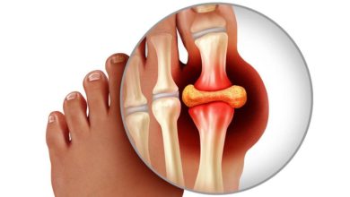النظام الغذائي لمرضى النقرس