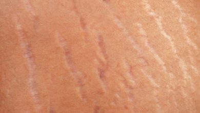 التخلص من علامات تمدد الجلد