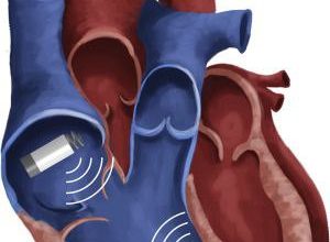 منظم لضربات القلب