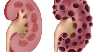 الفشل الكلوي الحاد