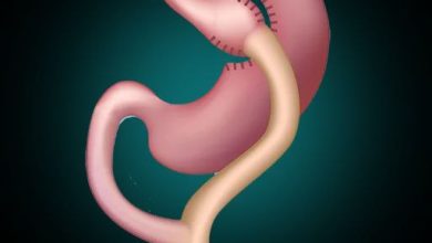 تحويل مسار المعدة