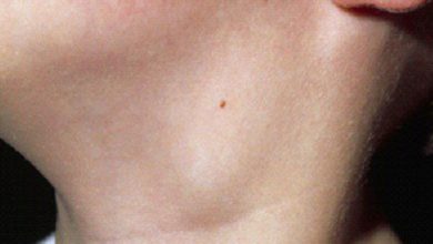 سرطان الغدد الليمفاوية