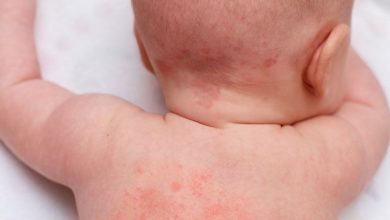 حمو النيل عند الأطفال