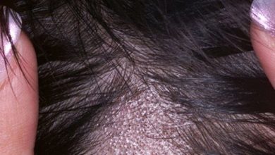 Alopecia