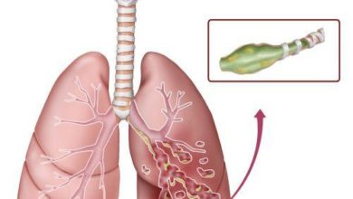 توسع القصبات الهوائية