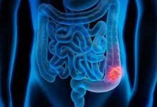 متلازمة لينش