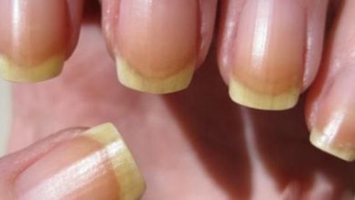 أسباب اصفرار الأظافر