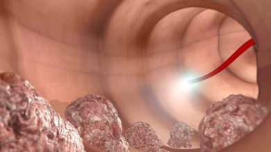 مرضى سرطان القولون